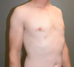 Male Breast Reduction Gynecomastia