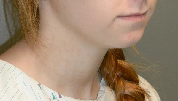 Chin Implant
