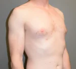 Male Breast Reduction Gynecomastia