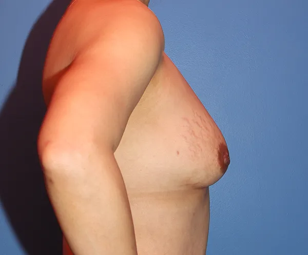 Breast Augmentation Fat