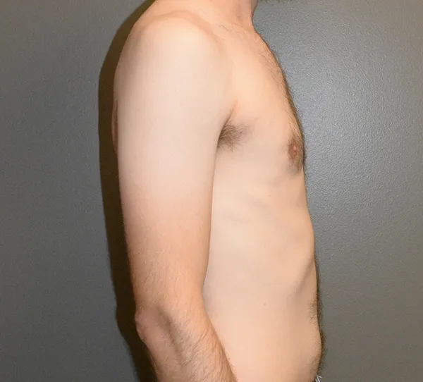 Male Breast Reduction Gynecomastia