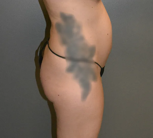 Liposuction