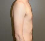Male Breast Reduction Gynecomastia