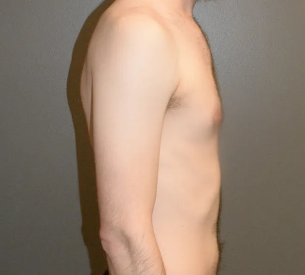Male Breast Reduction Gynecomastia