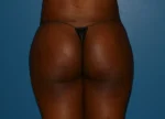 Brazilian Butt Lift