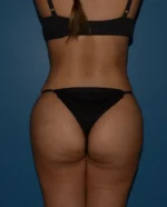 Butt Gluteal Implants