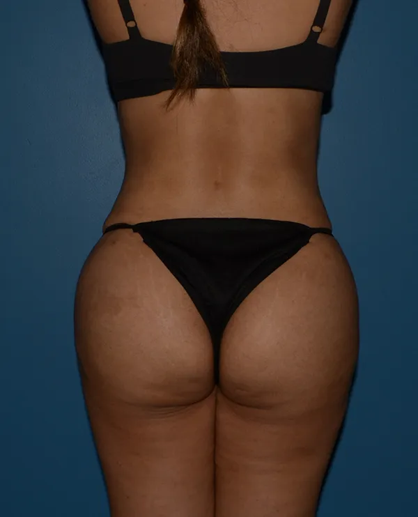 Butt Gluteal Implants