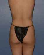 Butt Gluteal Implants
