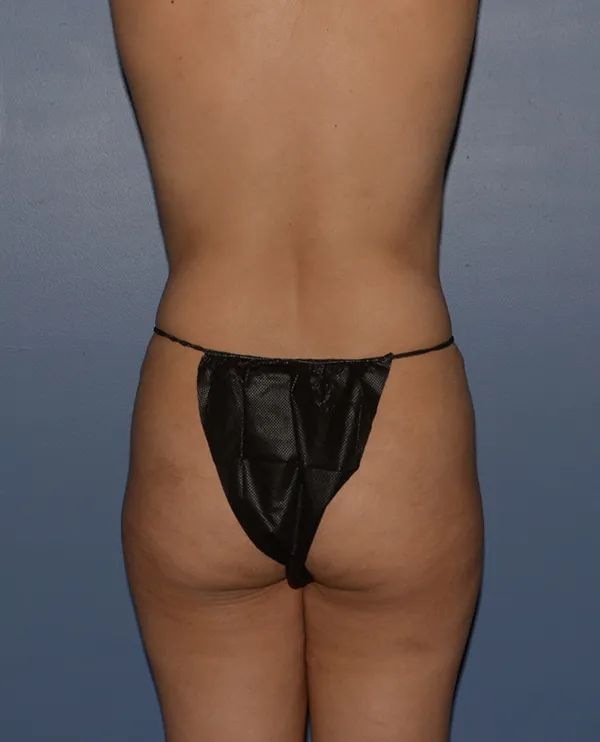Butt Gluteal Implants