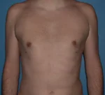 Male Breast Reduction Gynecomastia
