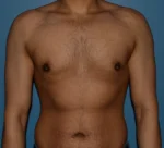 Male Breast Reduction Gynecomastia