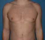 Male Breast Reduction Gynecomastia