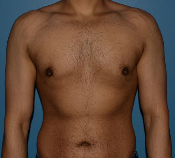 Male Breast Reduction Gynecomastia