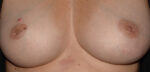 Nipple Correction