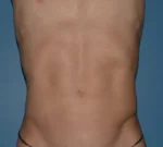 Liposuction