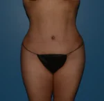 Tummy Tuck