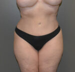 Tummy Tuck