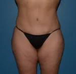 Tummy Tuck
