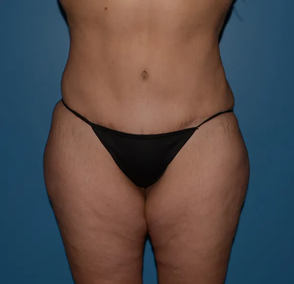 Tummy Tuck