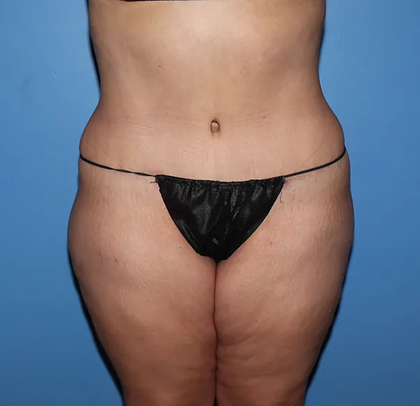 Tummy Tuck
