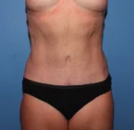 Tummy Tuck