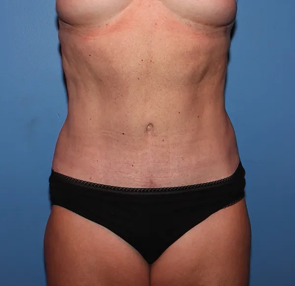 Tummy Tuck