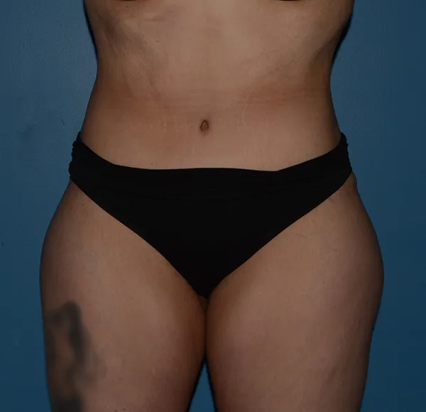 Tummy Tuck