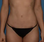 Tummy Tuck
