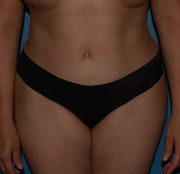 Tummy Tuck