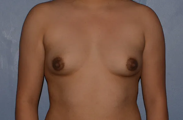 Breast Augmentation Implants