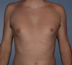 Male Breast Reduction Gynecomastia