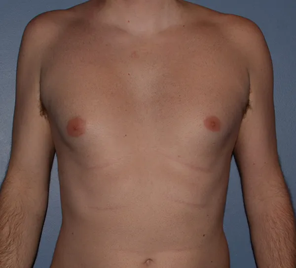 Male Breast Reduction Gynecomastia