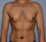 Male Breast Reduction Gynecomastia
