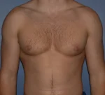 Male Breast Reduction Gynecomastia