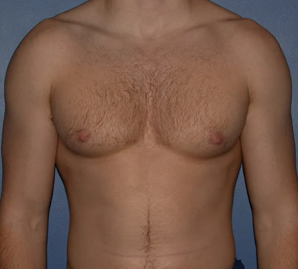 Male Breast Reduction Gynecomastia