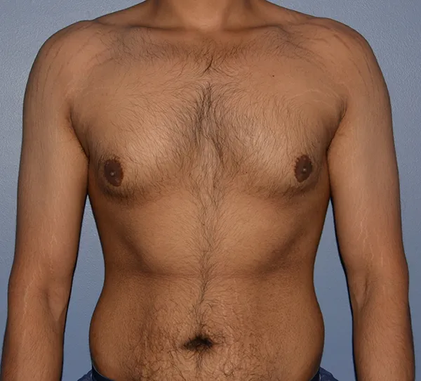 Male Breast Reduction Gynecomastia