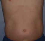 Liposuction