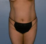 Tummy Tuck