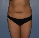 Tummy Tuck