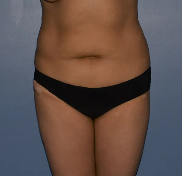 Tummy Tuck