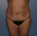 Tummy Tuck