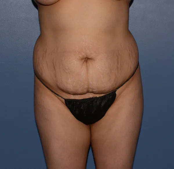 Tummy Tuck