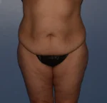 Tummy Tuck