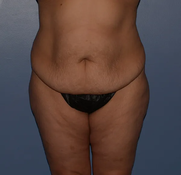 Tummy Tuck