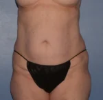Tummy Tuck