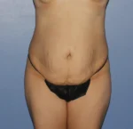 Tummy Tuck