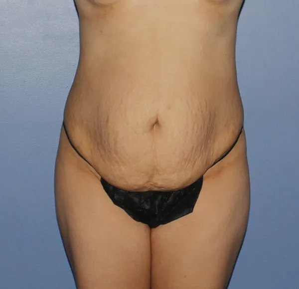 Tummy Tuck