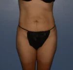 Tummy Tuck