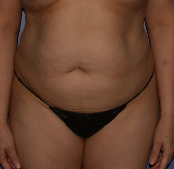 Tummy Tuck