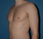 Male Breast Reduction Gynecomastia
